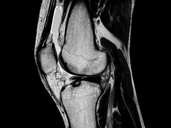 Ingenia Ambition 1.5T X: цифровая широкополосная архитектура dStream и Compressed SENSE MSK обеспечивают превосходное качество визуализации мягких тканей и костей для получения детальной информации о структуре костей, хрящей и менисков